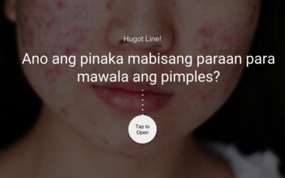 Ano ang pinaka mabisang paraan para mawala ang pimples?